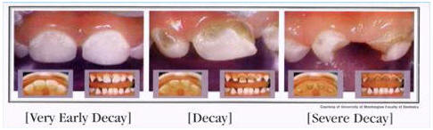 Dental Decay Stages